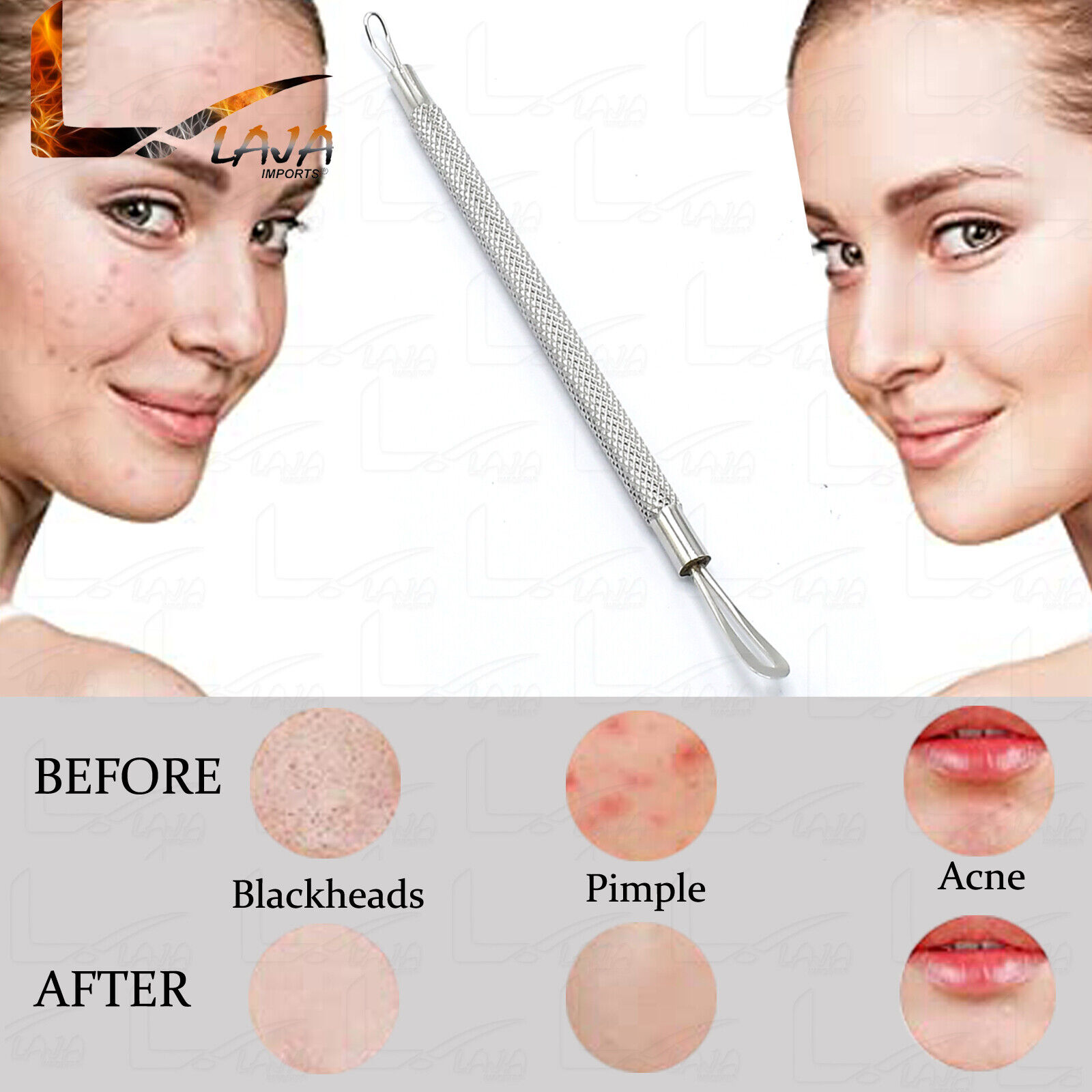 Comedone-Extractor-Blackhead-Remover-Tool-With-Dual-Loop-Stainless-Steel-New-273218200100-5